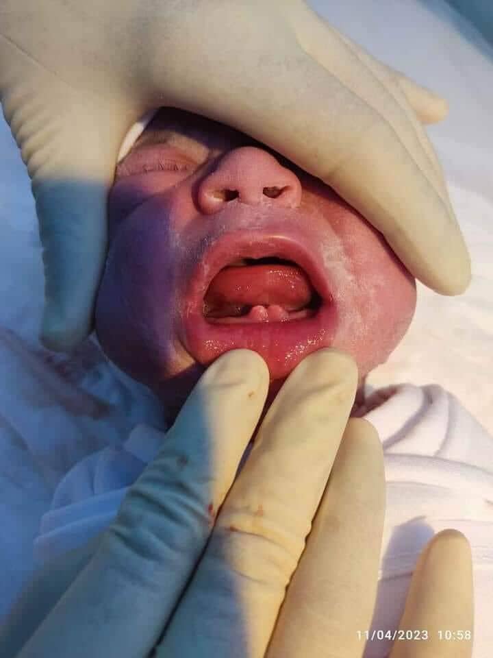 La naissance d'un enfant irakien atteint d'une maladie rare bebe