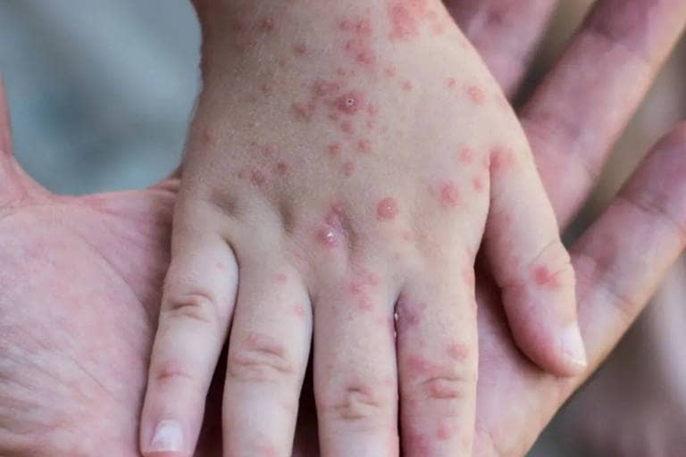 L'Algérie en alerte : Des mesures préventives pour bloquer la Variole du singe