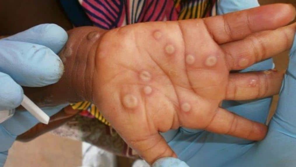 L'Algérie en alerte : Des mesures préventives pour bloquer la Variole du singe