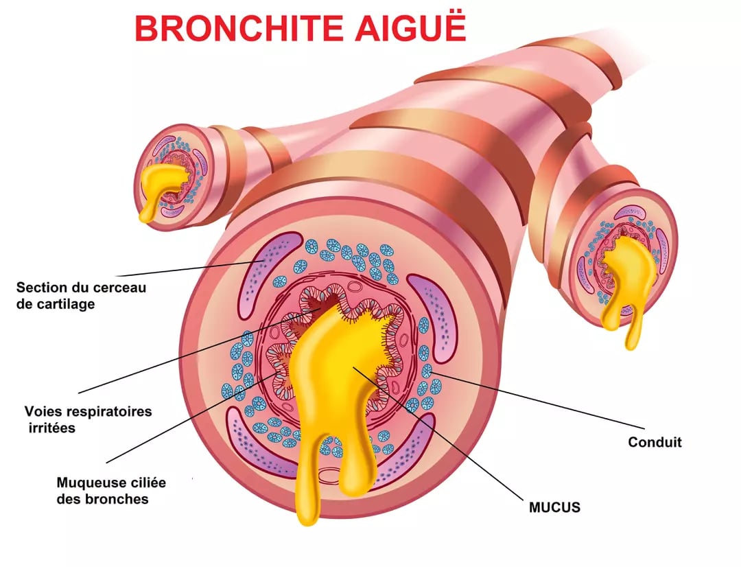Bronchite : symptômes, causes et traitements efficaces