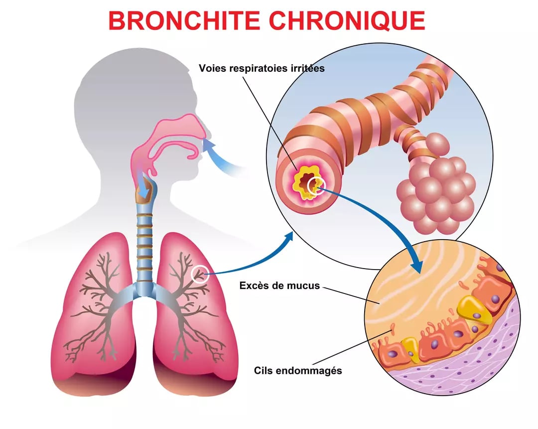 Bronchite : symptômes, causes et traitements efficaces
