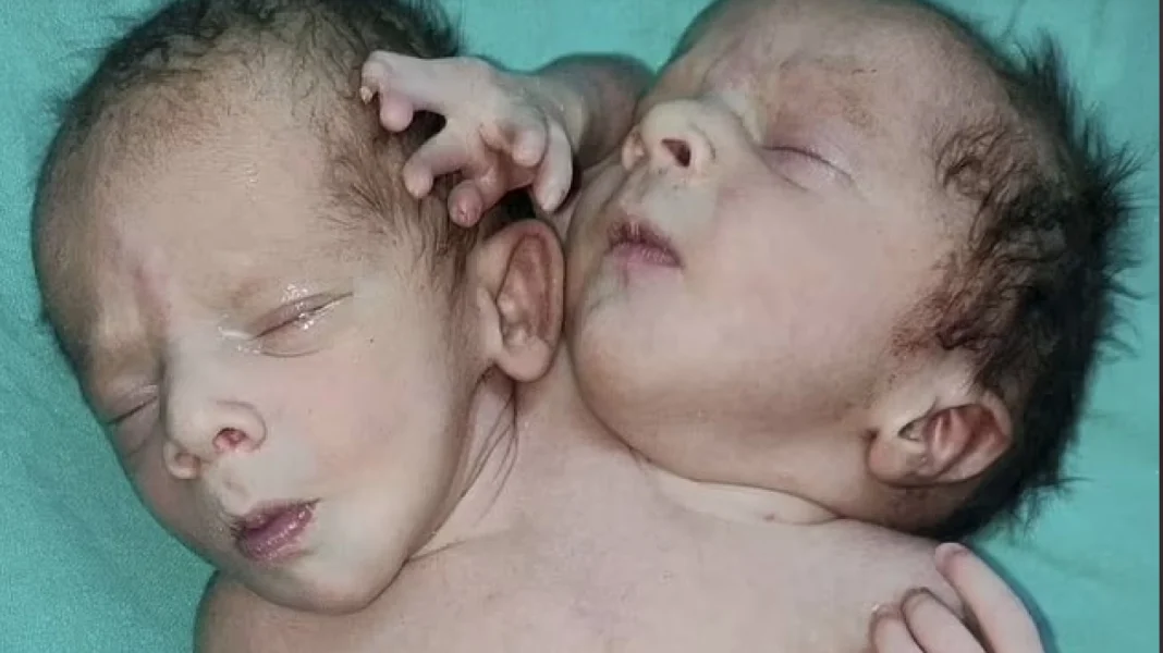 Inédit : Naissance d’un bébé à deux têtes, trois bras et deux cœurs Bébés jumeaux conjointe avec trois bras et deux cœurs visibles.