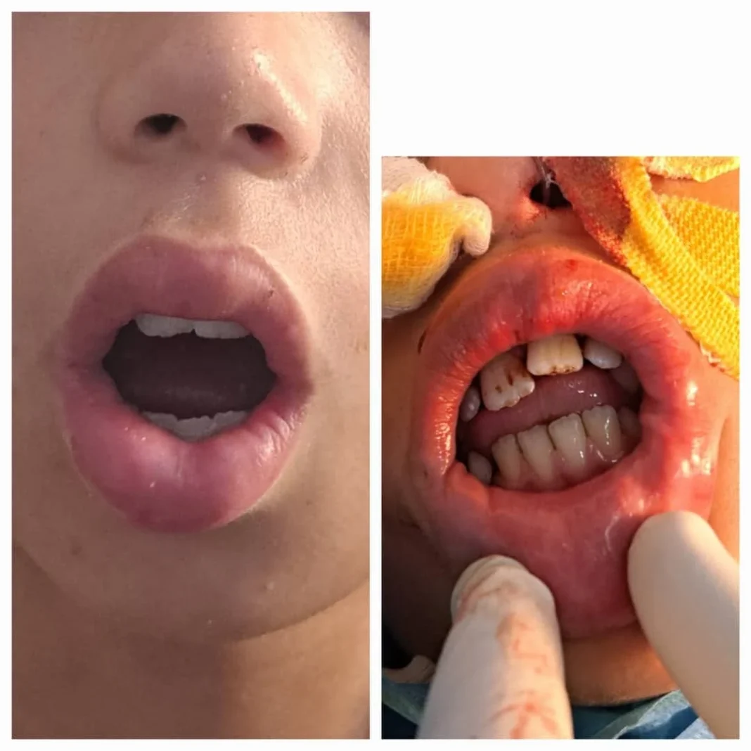 Prouesse médicale en Algérie : un homme retrouve l’usage de sa bouche après 14 ans Récupération de la fonction buccale après 14 ans en Algérie.